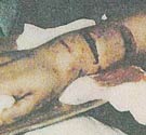 Yvonne Hyatt Yvonne Hyatt pit bull attack