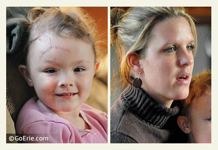 Alorah and Julie Havern 2 months after pit bull attack