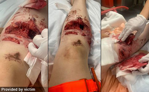devastating injuries - pit bul attack